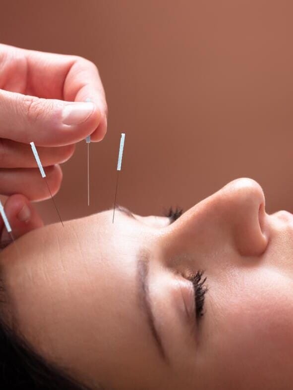 Cosmetisch acupunctuur