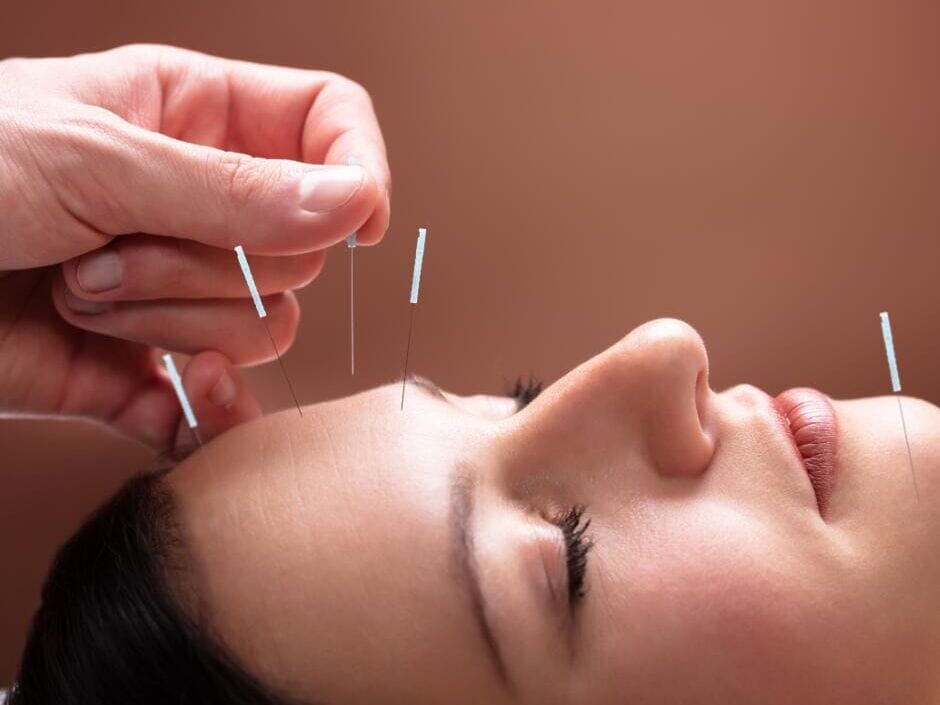 Cosmetisch acupunctuur